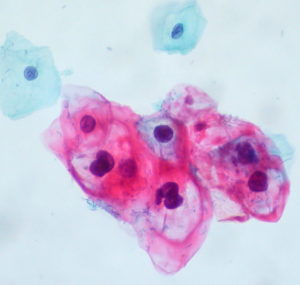 HPV Infected Cells